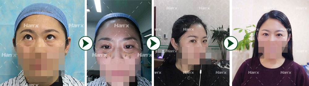 去眼袋真人案例