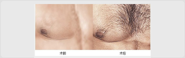 胸毛种植(图1)