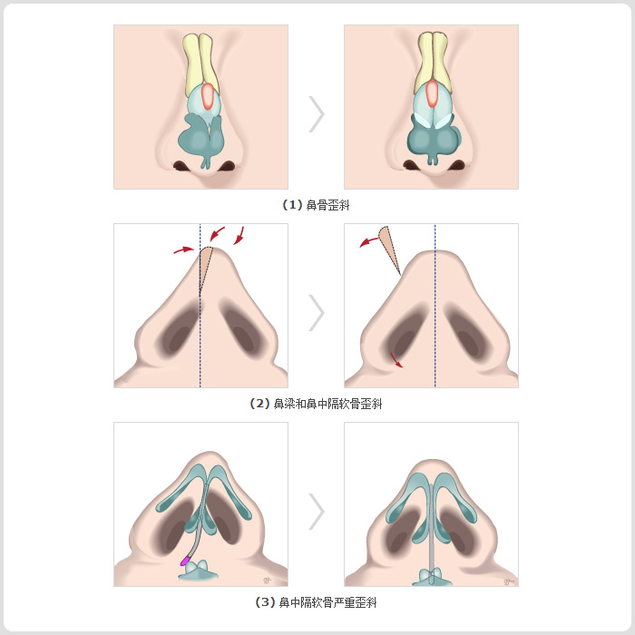 鼻部修复