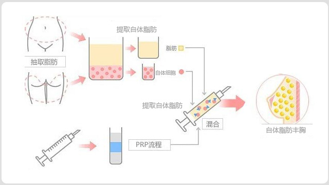 韩啸整形自体脂肪丰胸