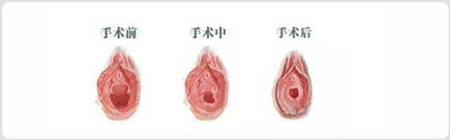 处女膜修补(图1)