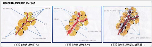 签约治疗终结妊娠纹