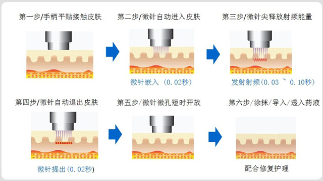 黄金微针