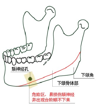 瘦脸术(图1)