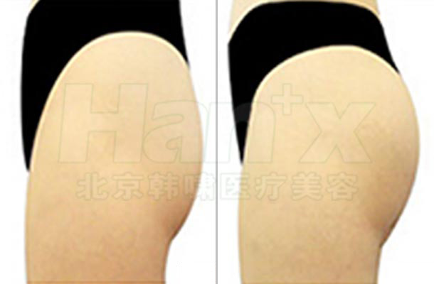 臀部整形(图2)