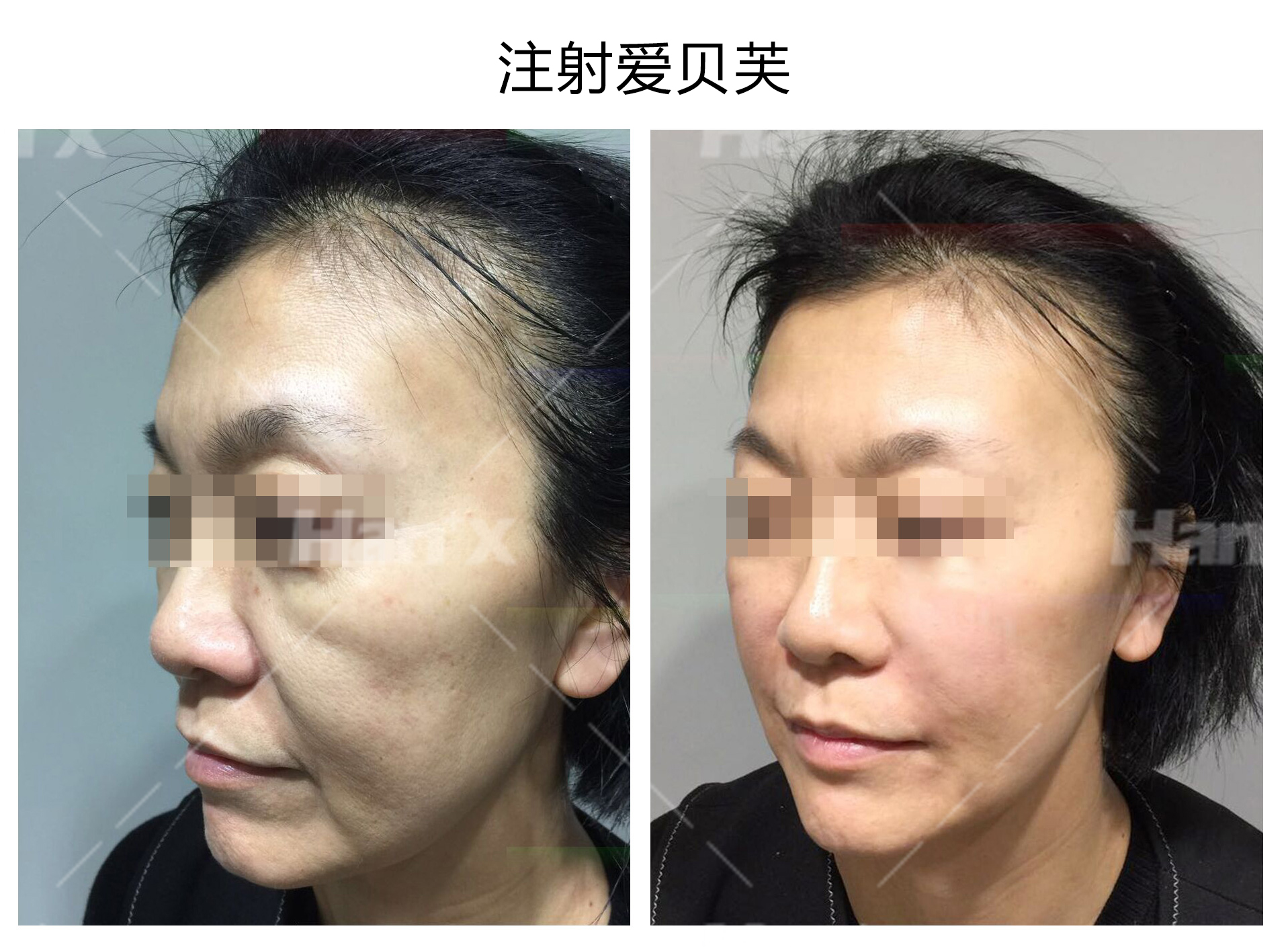 注射爱贝芙(图1)