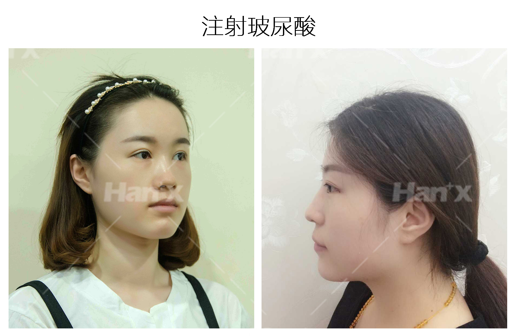 注射玻尿酸(图1)