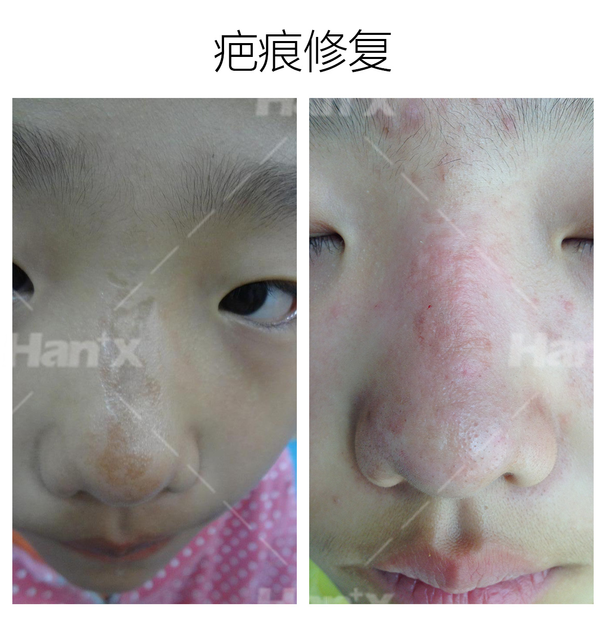 疤痕修复(图1)
