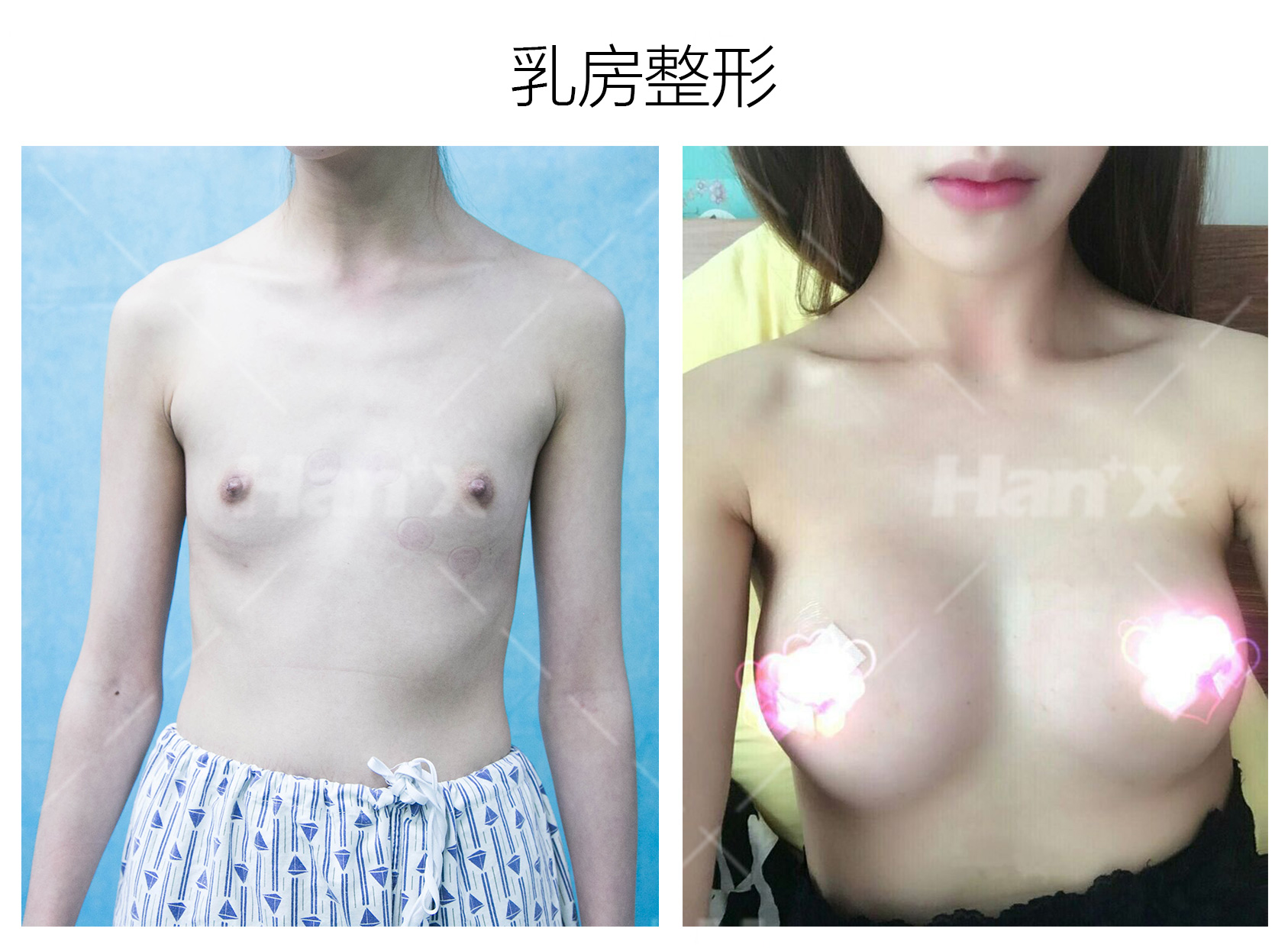 乳房整形(图1)