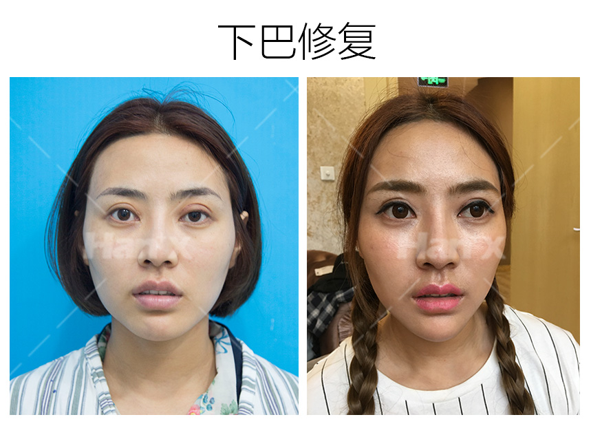 下巴修复(图1)