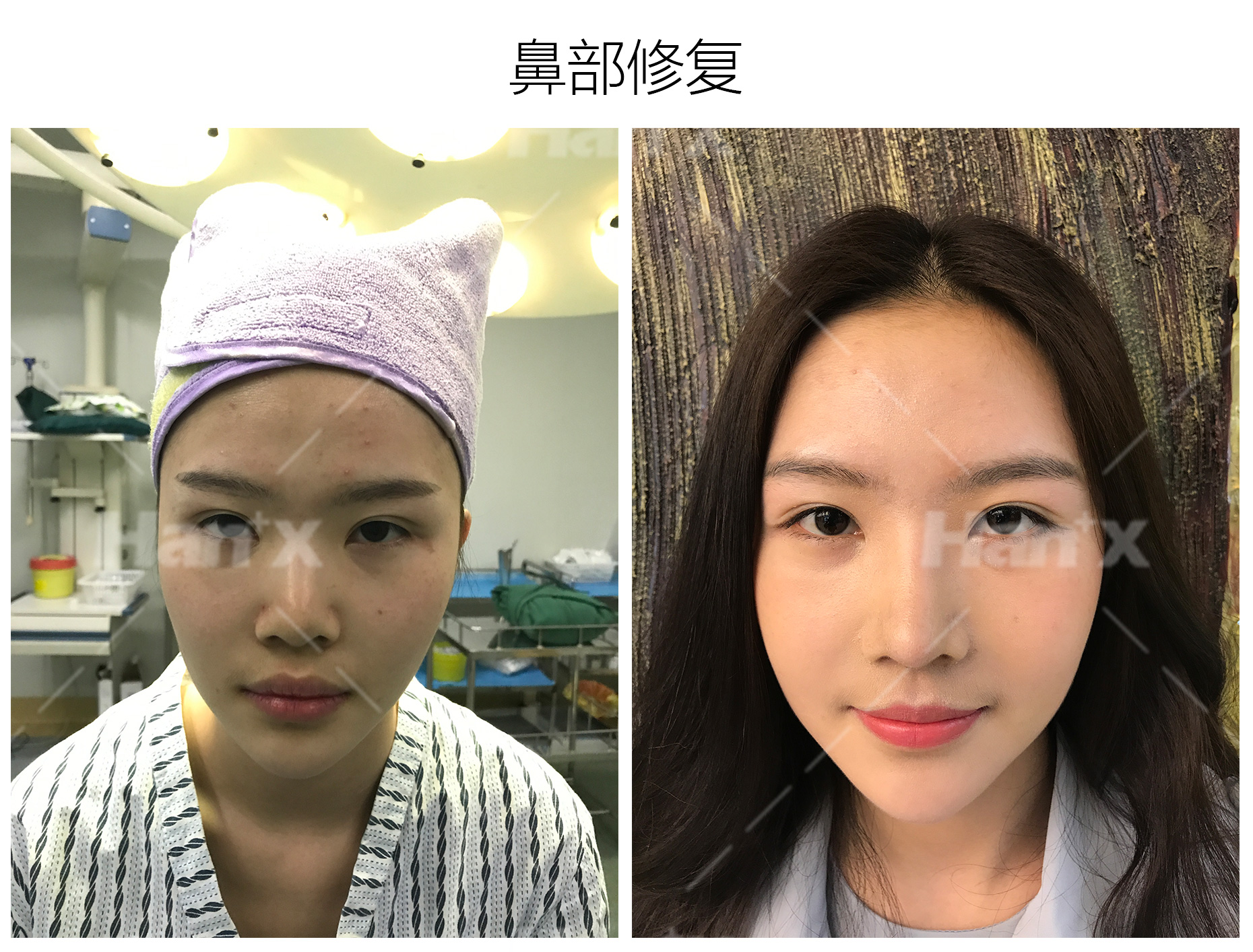 鼻部修复(图1)