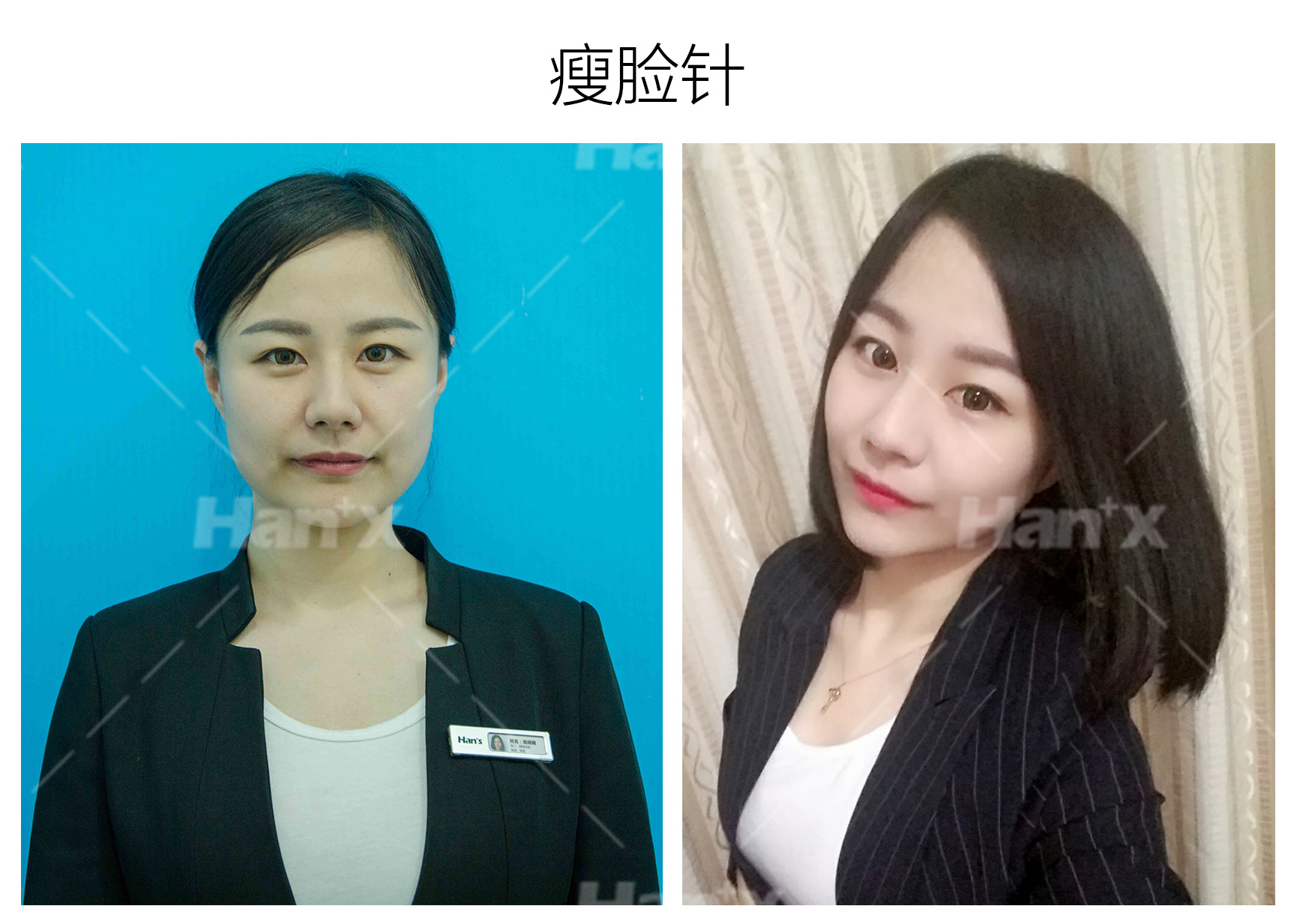 瘦脸术(图1)